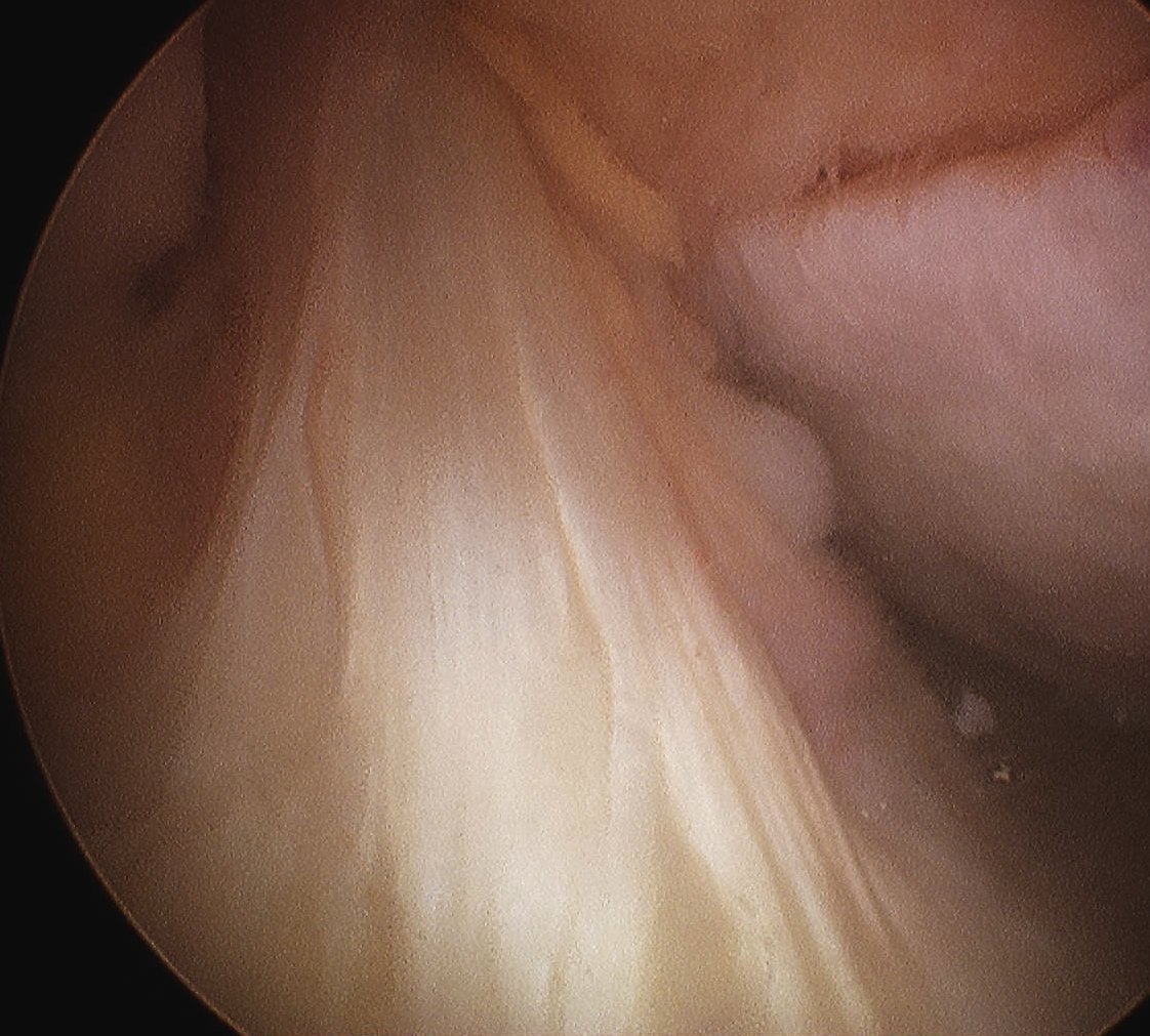 ACL Normal Arthroscopy